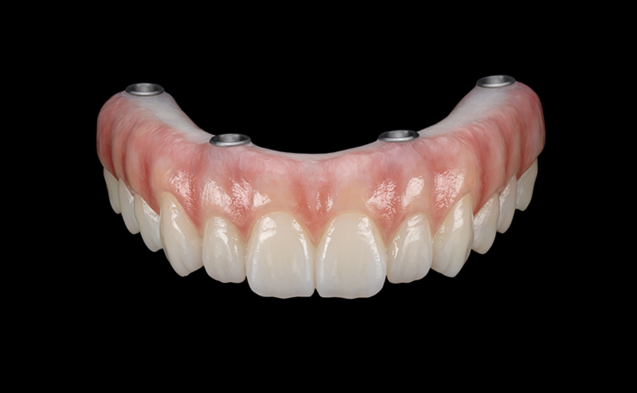 Implant