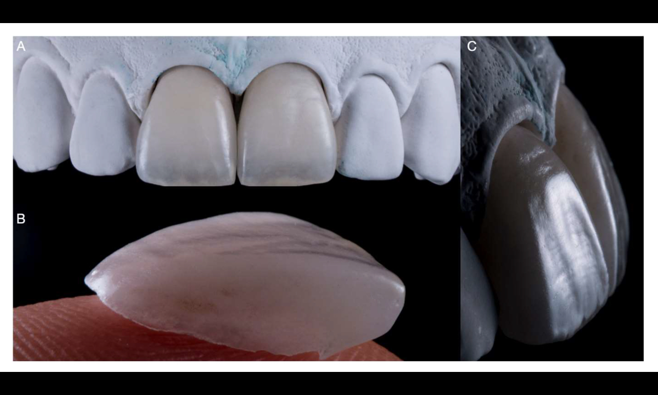 Veneer